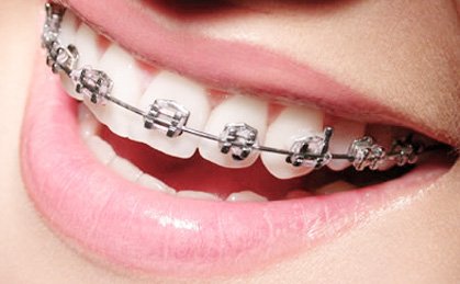 Sorriso com aparelho